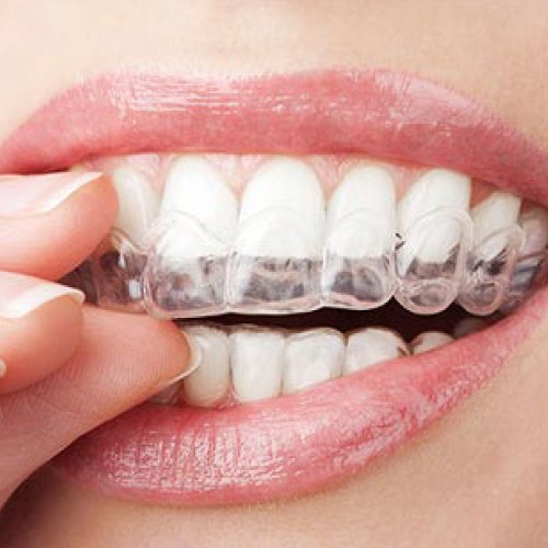 5 Reasons to Get Dental Braces