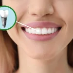 How To Choose The Right Teeth Implant