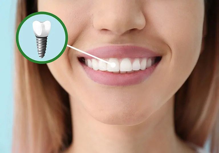 How To Choose The Right Teeth Implant